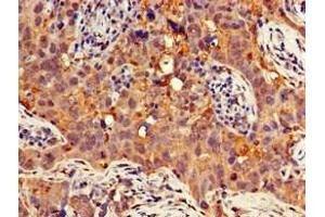 Immunohistochemistry of paraffin-embedded human pancreatic cancer using ABIN7154741 at dilution of 1:100 (GNB4 anticorps  (AA 105-185))