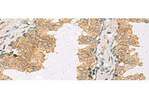 Immunohistochemistry of paraffin-embedded Human prost ate cancer tissue using SLC30A6 Polyclonal Antibody at dilution of 1:70(x200) (SLC30A6 anticorps)