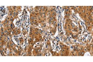 Immunohistochemistry of paraffin-embedded Human gastic cancer using BGN Polyclonal Antibody at dilution of 1:50