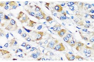Immunohistochemistry of paraffin-embedded Human liver cancer using TSC2 Polyclonal Antibody at dilution of 1:200 (40x lens). (Tuberin anticorps)