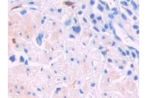 Detection of LCAT in Human Stomach cancer Tissue using Polyclonal Antibody to Lecithin Cholesterol Acyltransferase (LCAT) (LCAT anticorps  (AA 290-433))