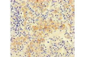 Immunohistochemistry of paraffin-embedded human lung cancer using ABIN7161144 at dilution of 1:100 (NEO1 anticorps  (AA 414-682))