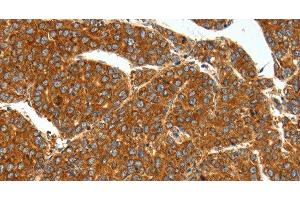 Immunohistochemistry of paraffin-embedded Human liver cancer using SSTR1 Polyclonal Antibody at dilution of 1:40 (SSTR1 anticorps)