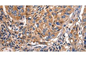 Immunohistochemistry of paraffin-embedded Human lung cancer tissue using Galectin 8 Polyclonal Antibody at dilution 1:50 (LGALS8 anticorps)