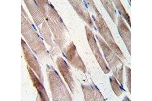 Desmin antibody staining of human hepatocarcinoma tissue