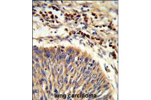 Formalin-fixed and paraffin-embedded human lung carcinoma reacted with HSPA6 Antibody , which was peroxidase-conjugated to the secondary antibody, followed by DAB staining.