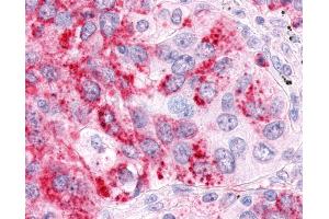 Anti-ESRRA / ERR Alpha antibody IHC of human Lung, Non-Small Cell Carcinoma.