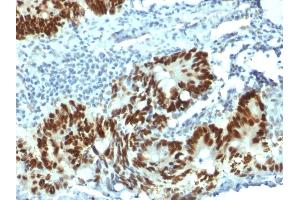 Formalin-fixed, paraffin-embedded human Colon Carcinoma stained with p53 Mouse Monoclonal Antibody (PAb1801). (p53 anticorps)