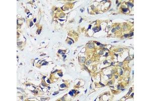 Immunohistochemistry of paraffin-embedded Human breast cancer using CCDC124 Polyclonal Antibody at dilution of 1:100 (40x lens). (CCDC124 anticorps)