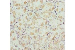 Immunohistochemistry of paraffin-embedded human gastric cancer using ABIN7168446 at dilution of 1:100 (ROBO3 anticorps  (AA 1237-1386))