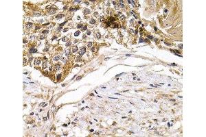 Immunohistochemistry of paraffin-embedded Human breast cancer using ARRB2 Polyclonal Antibody at dilution of 1:200 (40x lens). (Arrestin 3 anticorps)