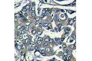 IHC analysis of formalin fixed paraffin embedded human breast carcinoma stained with EIF4E2 antibody (EIF4E2 anticorps  (AA 12-41))