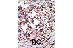 Formalin-fixed and paraffin-embedded human cancer tissue reacted with PRKCB polyclonal antibody  , which was peroxidase-conjugated to the secondary antibody, followed by AEC staining . (PKC beta anticorps  (C-Term))