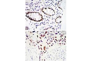 Immunohistochemical analysis of paraffin-embedded human colon cancer tissues (upper) and lung cancer tissues (bottom) using KLF4 monoclonal antibody, clone 1E6  with DAB staining. (KLF4 anticorps)