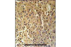 DHB13 Antibody immunohistochemistry analysis in formalin fixed and paraffin embedded human hepatocarcinoma followed by peroxidase conjugation of the secondary antibody and DAB staining.