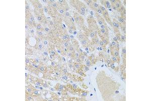 Immunohistochemistry of paraffin-embedded human liver injury using DLK1 antibody (ABIN2562237) at dilution of 1:100 (40x lens). (DLK1 anticorps)