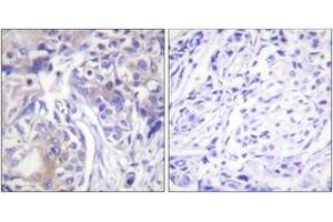 Immunohistochemistry analysis of paraffin-embedded human breast carcinoma tissue, using ADD1 (Ab-445) Antibody. (alpha Adducin anticorps  (AA 411-460))