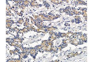 ABIN7096488 and ABIN7100552 at 1/100 staining human colorectal cancer by IHC-P.