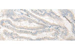 Immunohistochemistry of paraffin-embedded Human thyroid cancer tissue using DNASE1L1 Polyclonal Antibody at dilution of 1:25(x200) (DNASEX anticorps)