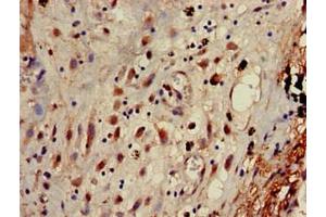 Immunohistochemistry of paraffin-embedded human lung cancer using ABIN7144346 at dilution of 1:100 (gamma 1 Adaptin anticorps  (AA 592-686))