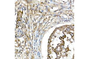 Immunohistochemistry of paraffin-embedded human lung cancer using TNF Rabbit pAb (ABIN3022984, ABIN3022985, ABIN3022986 and ABIN6219332) at dilution of 1:50 (40x lens).
