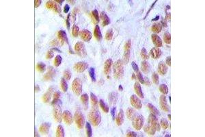 Immunohistochemical analysis of HMGB1 staining in human breast cancer formalin fixed paraffin embedded tissue section. (HMGB1 anticorps)