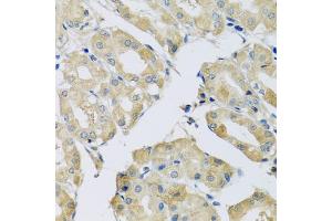 Immunohistochemistry of paraffin-embedded human stomach using ABCF2 antibody (ABIN5972445) at dilution of 1/100 (40x lens). (ABCF2 anticorps)