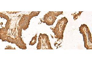 Immunohistochemistry of paraffin-embedded Human thyroid cancer tissue using ZBTB43 Polyclonal Antibody at dilution of 1:40(x200)