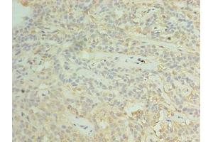 Immunohistochemistry of paraffin-embedded human breast cancer using ABIN7170641 at dilution of 1:100 (RBM11 anticorps  (AA 115-278))