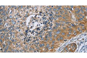 Immunohistochemistry of paraffin-embedded Human cervical cancer tissue using ZMYND11 Polyclonal Antibody at dilution 1:70