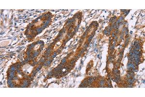 Immunohistochemistry of paraffin-embedded Human colon cancer using CLP36 Polyclonal Antibody at dilution of 1:30 (PDLIM1 anticorps)