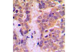 Immunohistochemical analysis of Caspase 9 staining in human breast cancer formalin fixed paraffin embedded tissue section. (Caspase 9 anticorps  (Center))
