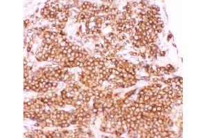 IHC-P: p50 antibody testing of human lung cancer tissue