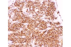IHC-P: p50 antibody testing of human lung cancer tissue (CD40 anticorps  (AA 1-360))