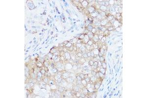 Immunohistochemistry of paraffin-embedded human breast cancer using EIF4G1 Rabbit pAb (ABIN6134646, ABIN6140092, ABIN6140093 and ABIN6221701) at dilution of 1:100 (40x lens).