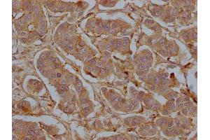 IHC image of ABIN7147203 diluted at 1:50 and staining in paraffin-embedded human breast cancer tissue performed on a Leica BondTM system. (CD9 anticorps  (AA 112-195))