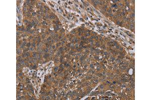Immunohistochemistry of Human lung cancer using OXTR Polyclonal Antibody at dilution of 1:40 (Oxytocin Receptor anticorps)