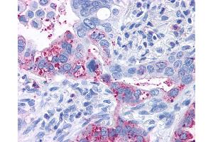 Anti-GPR6 antibody IHC of human Lung, Adenocarcinoma.