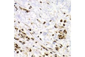 Immunohistochemistry of paraffin-embedded human kidney cancer using SUMO4 Antibody.