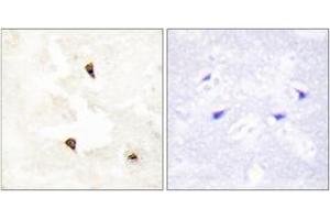 Immunohistochemistry analysis of paraffin-embedded human breast carcinoma tissue, using TP53I11 Antibody. (TP53I11 anticorps  (AA 71-120))