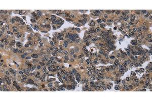 Immunohistochemistry of paraffin-embedded Human ovarian cancer using ITGAE Polyclonal Antibody at dilution of 1:50 (CD103 anticorps)