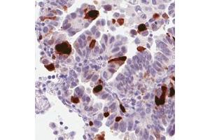 Immunohistochemical staining (Formalin-fixed paraffin-embedded sections) of human lung adenocarcinoma with ANLN monoclonal antibody, clone CL0301  shows strong nuclear immunoreactivity in a subset of tumor cells.