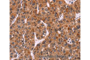 Immunohistochemistry of Human colon cancer using CARD11 Polyclonal Antibody at dilution of 1:40 (CARD11 anticorps)