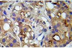 Immunohistochemistry (IHC) analyzes of p-c-RAF (pSer259) pAb in paraffin-embedded human prostate carcinoma tissue. (RAF1 anticorps  (pSer259))