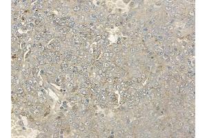 ABIN6256476 and ABIN6278655 at 1/100 staining human melanoma by IHC-P.