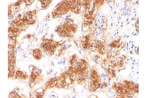 Formalin-fixed, paraffin-embedded human Breast Carcinoma stained with Milk Fat Globule Monoclonal Antibody (SPM291) (MFGE8 anticorps)