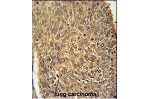 ATG13 Antibody (N-term) (ABIN653882 and ABIN2843129) immunohistochemistry analysis in formalin fixed and paraffin embedded human lung carcinoma followed by peroxidase conjugation of the secondary antibody and DAB staining. (ATG13 anticorps  (N-Term))
