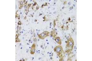 Immunohistochemistry of paraffin-embedded human liver cancer using GATM Antibody (ABIN5973965) at dilution of 1/100 (40x lens). (GATM anticorps)