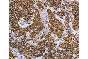 Immunohistochemistry of Human colon cancer using CCL21 Polyclonal Antibody at dilution of 1:40 (CCL21 anticorps)