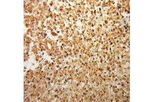 Immunohistochemistry of paraffin-embedded Osteosarcoma using FGF2 antibody. (FGF2 anticorps  (AA 143-288))